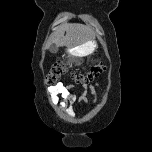 File:Acute pancreatitis (Radiopaedia 20829-20744 Coronal C+ portal venous phase 10).jpg