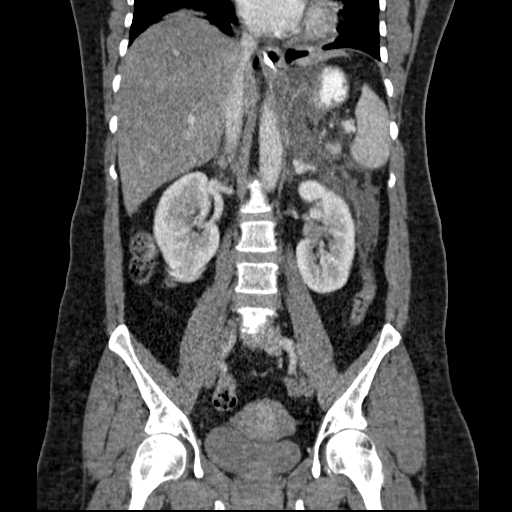 File:Acute pancreatitis (Radiopaedia 20829-20744 Coronal C+ portal venous phase 33).jpg