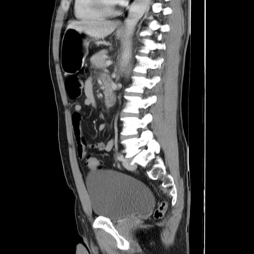 Acute pancreatitis (Radiopaedia 22572-22596 Sagittal C+ portal venous phase 32).jpg