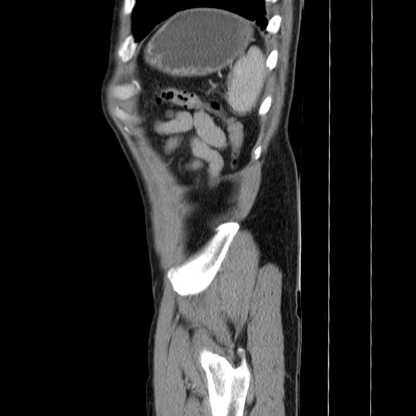 Acute pancreatitis (Radiopaedia 22572-22596 Sagittal C+ portal venous phase 48).jpg