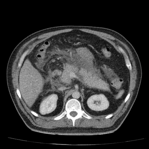 Acute pancreatitis (Radiopaedia 26663-26813 Axial C+ portal venous phase 28).jpg