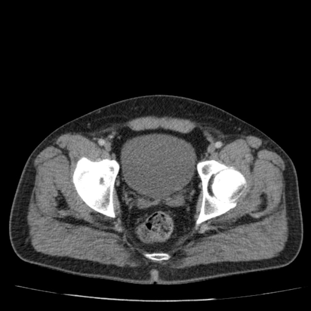 Acute pancreatitis (Radiopaedia 26663-26813 Axial C+ portal venous phase 81).jpg