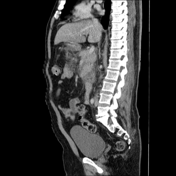 Acute pancreatitis (Radiopaedia 26663-26813 Sagittal C+ portal venous phase 35).jpg