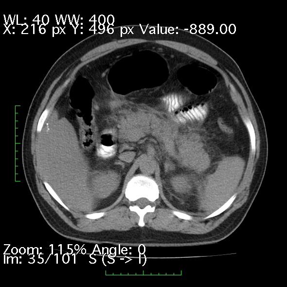 Acute pancreatitis (Radiopaedia 34043-35276 Axial non-contrast 35).jpg