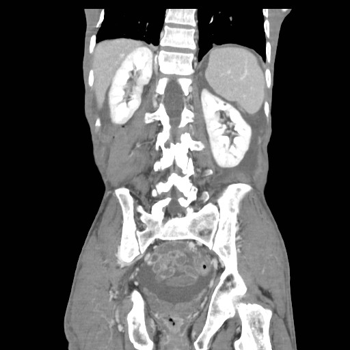 File:Acute pancreatitis (Radiopaedia 50213-55558 Coronal C+ portal venous phase 35).jpg