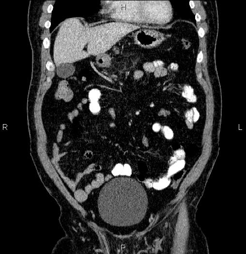 Acute pancreatitis (Radiopaedia 85390-101010 Coronal C+ portal venous phase 18).jpg