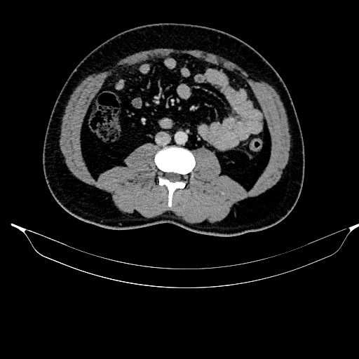 Acute pancreatitis (Radiopaedia 87428-103757 Axial C+ portal venous phase 57).jpg