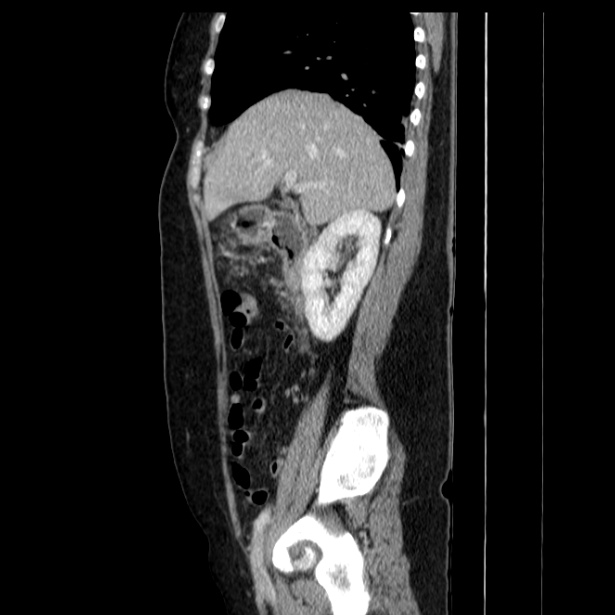 Acute pancreatitis - Balthazar C (Radiopaedia 26569-26714 Sagittal C+ portal venous phase 24).jpg