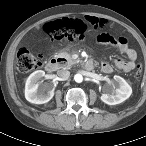 File:Acute pancreatitis and walled-off necrosis (Radiopaedia 29888-30403 Axial C+ portal venous phase 22).jpg