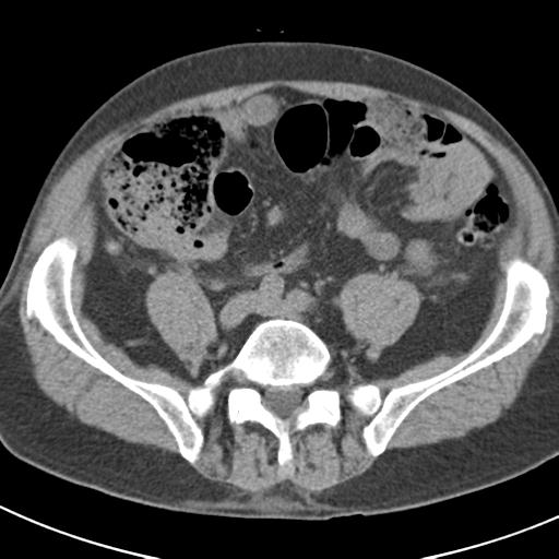 File:Acute pancreatitis and walled-off necrosis (Radiopaedia 29888-30403 Axial non-contrast 52).jpg
