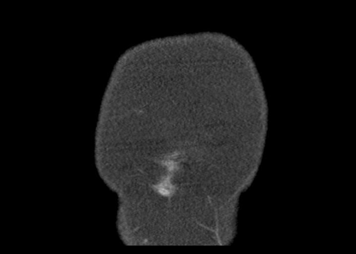 Acute pancreatitis and walled-off necrosis (Radiopaedia 29888-30403 Coronal C+ portal venous phase 5).jpg