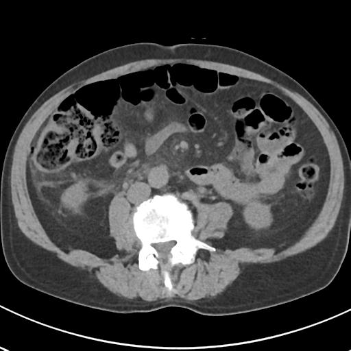 File:Acute pancreatitis and walled-off necrosis (Radiopaedia 29888-30404 Axial non-contrast 45).jpg