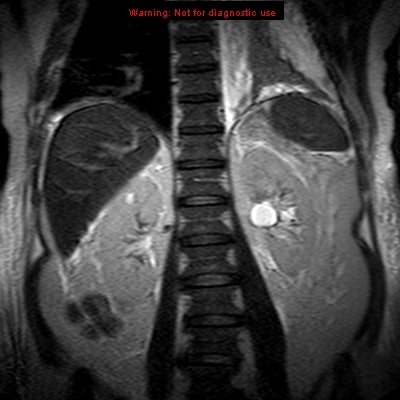 File:Acute pancreatitis with incidental pancreatic lipoma (Radiopaedia 10190-10732 Coronal T2 23).jpg