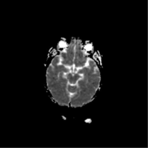 File:Acute pontine infarct from vertebral artery dissection (Radiopaedia 34111-35370 Axial ADC 9).png