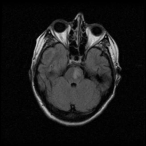 File:Acute pontine infarct from vertebral artery dissection (Radiopaedia 34111-35370 Axial FLAIR 6).png