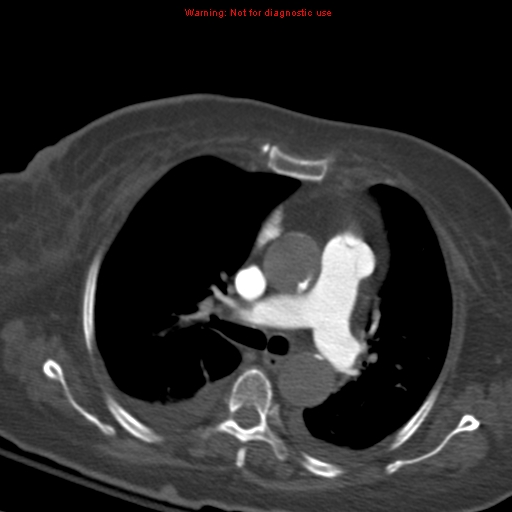 Acute pulmonary embolism (Radiopaedia 13286-13289 Axial C+ CTPA 29).jpg