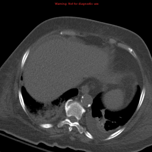 Acute pulmonary embolism (Radiopaedia 13286-13289 Axial C+ CTPA 56).jpg