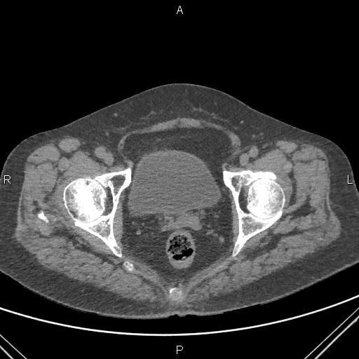 Acute renal artery occlusion (Radiopaedia 86586-102682 Axial non-contrast 88).jpg