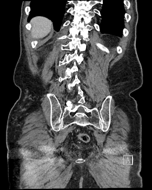 Acute renal infarction - rim capsular enhancement (Radiopaedia 59833-67270 Coronal C+ portal venous phase 56).jpg