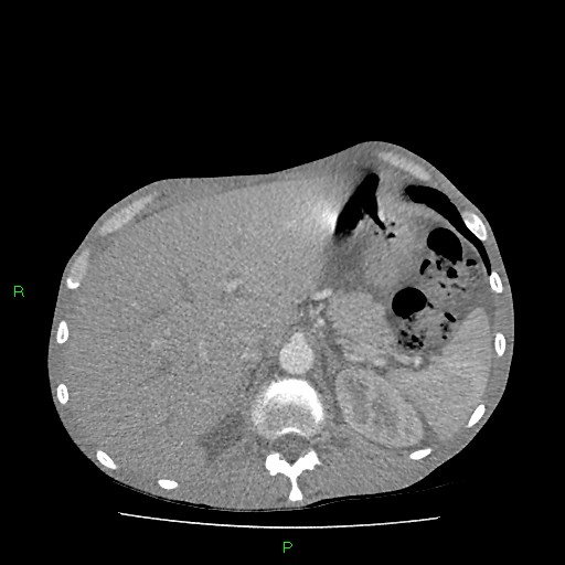 File:Acute right lung abscess (Radiopaedia 34806-36258 Axial C+ arterial phase 183).jpg