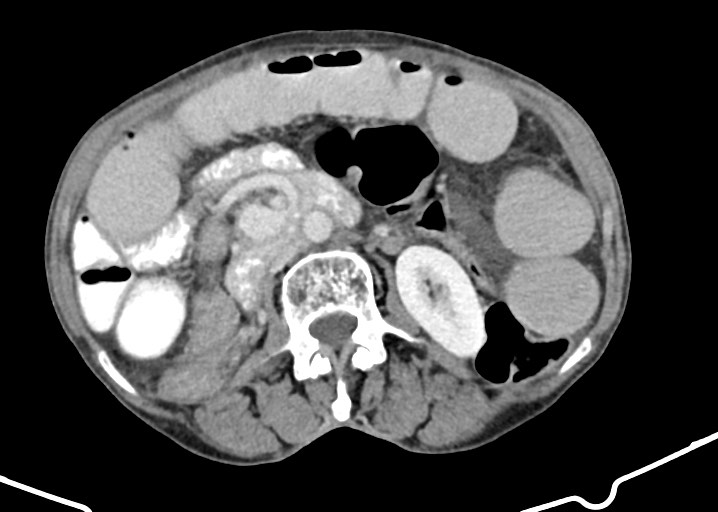 Acute small bowel (ileal) volvulus (Radiopaedia 71740-82139 Axial C+ portal venous phase 95).jpg