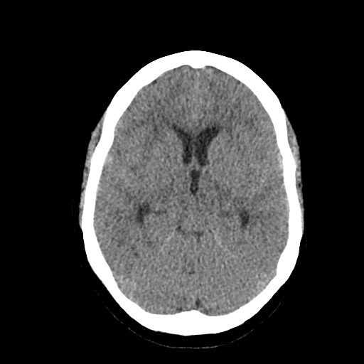 Acute subarachnoid hemorrhage and accessory anterior cerebral artery (Radiopaedia 69231-79008 Axial non-contrast 23).jpg