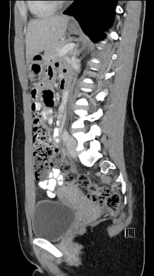 Acute uncomplicated appendicitis (Radiopaedia 61374-69304 Sagittal C+ portal venous phase 44).jpg