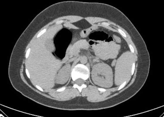 Acute unilateral nonhemorrhagic adrenal infarction (Radiopaedia 67560-76957 Axial non-contrast 41).jpg