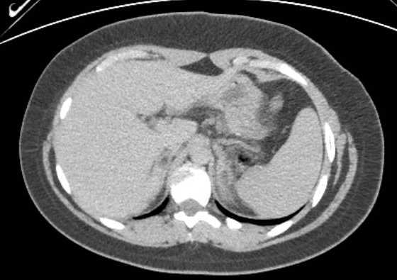 File:Acute unilateral nonhemorrhagic adrenal infarction (Radiopaedia 67560-76957 Axial renal excretory phase 19).jpg
