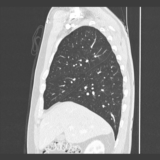 Adenocarcinoma of the lung (Radiopaedia 59871-67325 Sagittal lung window 26).jpg