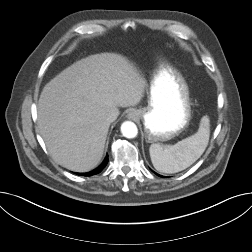 Adenocarcioma of rectum- T1 lesion (Radiopaedia 36921-38547 Axial C+ arterial phase 48).png