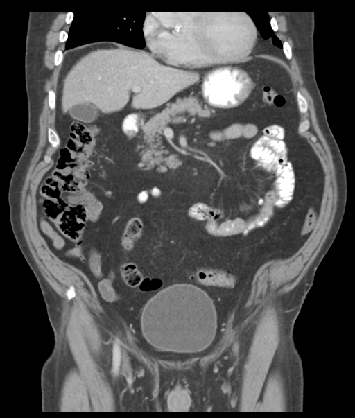 Adenocarcioma of rectum- T1 lesion (Radiopaedia 36921-38547 Coronal C+ portal venous phase 25).png