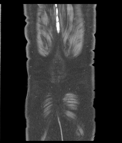Adenocarcioma of rectum- T1 lesion (Radiopaedia 36921-38547 Coronal C+ portal venous phase 60).png