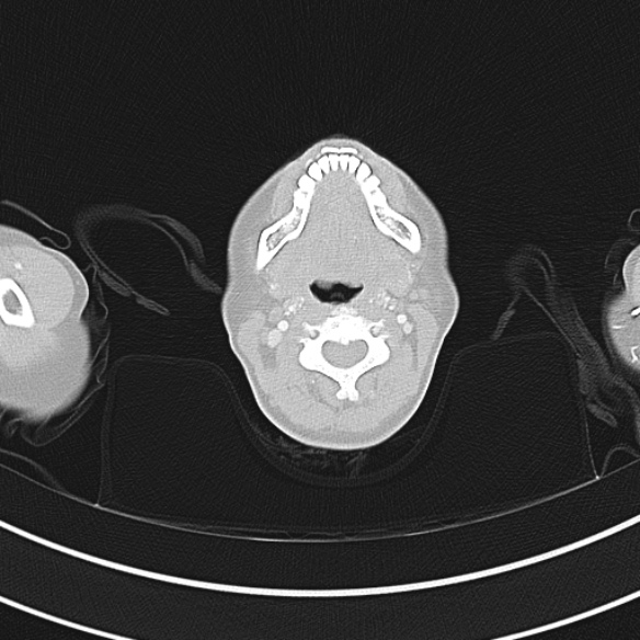 File:Adenocystic carcinoma of the trachea (Radiopaedia 47677-52525 Axial lung window 13).jpg