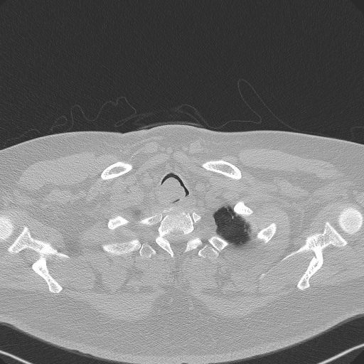 Adenoid cystic carcinoma of the trachea (Radiopaedia 49042-54137 Axial lung window 22).jpg