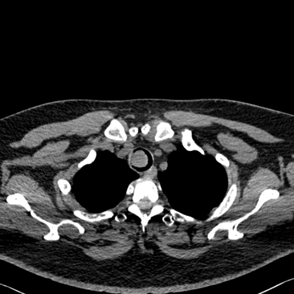 Adenoid cystic carcinoma of the trachea (Radiopaedia 49042-54137 Axial non-contrast 46).jpg