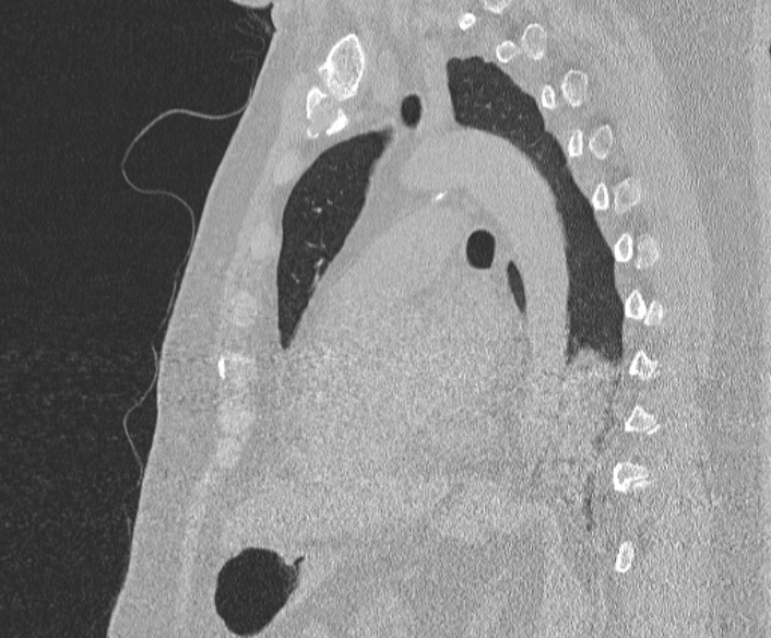 Adenoid cystic carcinoma of the trachea (Radiopaedia 49042-54137 Sagittal lung window 277).jpg
