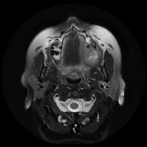 File:Adenoid cystic tumor of palate (Radiopaedia 46980-51519 Axial T2 20).png