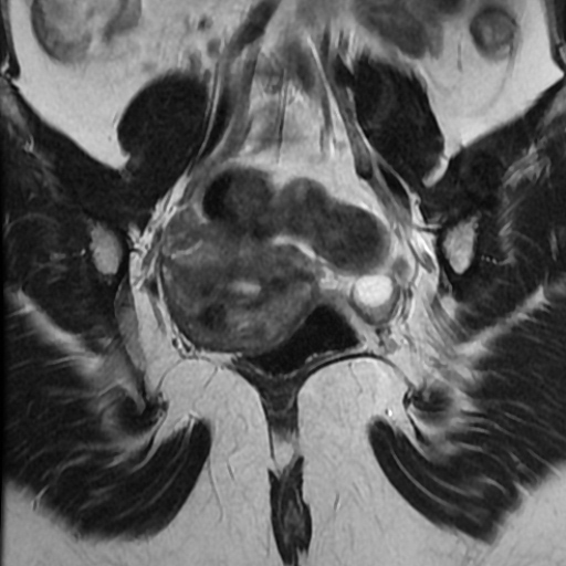 File:Adenoma malignum of cervix (Radiopaedia 66441-75705 Coronal T2 15).jpg