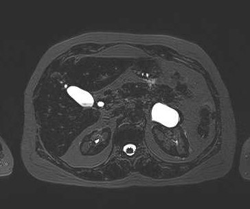 File:Adenomyomatosis of the gallbladder (Radiopaedia 50246-55587 Axial 58).png