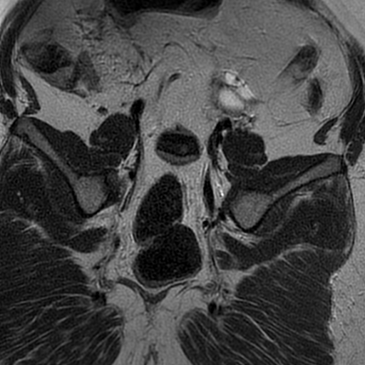 File:Adenomyosis within a didelphys uterus (Radiopaedia 70175-80215 Coronal T2 28).jpg