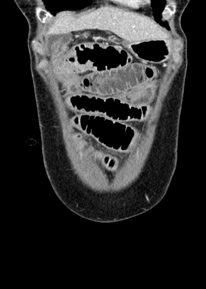 Adhesional small bowel obstruction (Radiopaedia 48397-53305 Coronal C+ portal venous phase 56).jpg