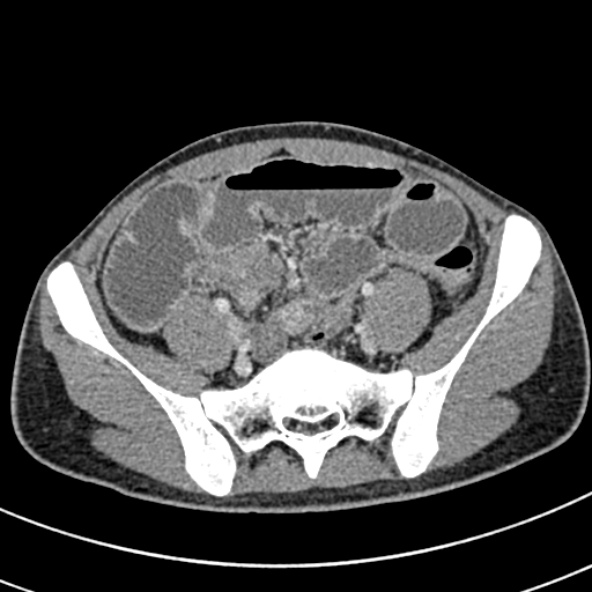 File:Adhesional small bowel obstruction (Radiopaedia 52107-57980 Axial C+ portal venous phase 94).jpg