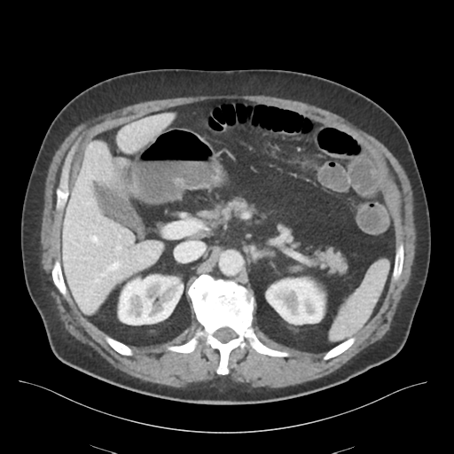 Adhesions within abdominal wall hernia (Radiopaedia 58283-65394 Axial C+ portal venous phase 27).png