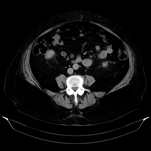 Adrenal cortical carcinoma (Radiopaedia 64017-72769 Axial C+ delayed 44).jpg