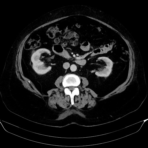 Adrenal cortical carcinoma (Radiopaedia 64017-72769 Axial C+ portal venous phase 33).jpg