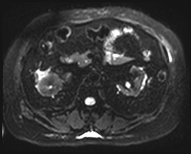Adrenal cortical carcinoma (Radiopaedia 64017-72770 Axial DWI 23).jpg