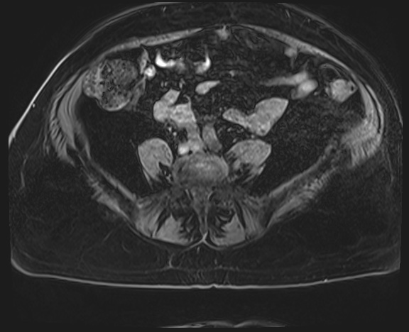 Adrenal cortical carcinoma (Radiopaedia 64017-72770 Axial T1 C+ fat sat 59).jpg
