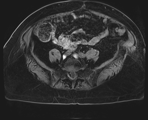 Adrenal cortical carcinoma (Radiopaedia 64017-72770 Axial T1 C+ fat sat 65).jpg