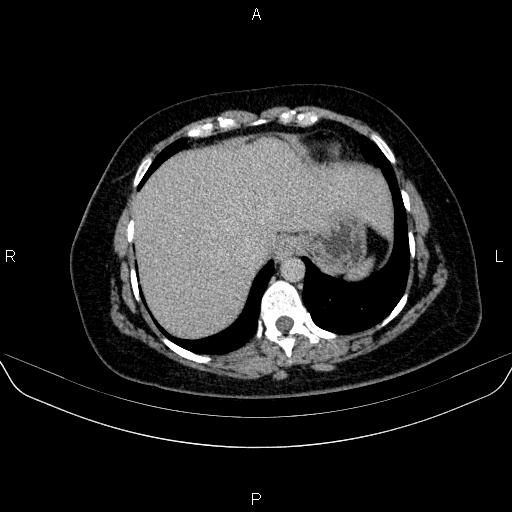Adrenal cortical carcinoma (Radiopaedia 84882-100379 Axial C+ delayed 9).jpg